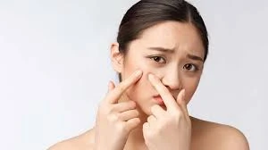 যে পানীয় পানে এক মাসেই মিলবে ব্রণ থেকে মুক্তি!