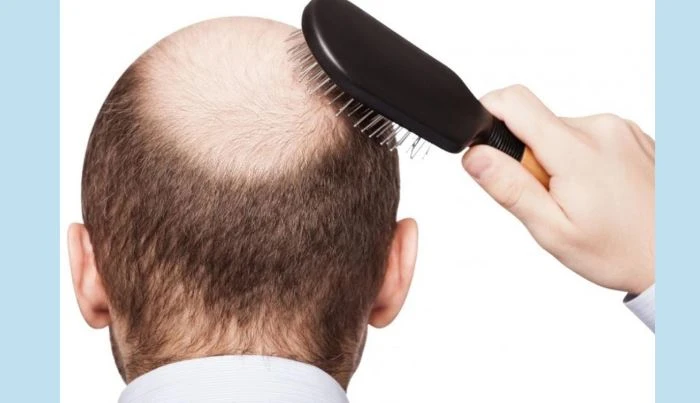 টাক পড়া কি হৃদরোগের ঝুঁকি বাড়ায়? যা বলছে বিজ্ঞান গবেষণায়