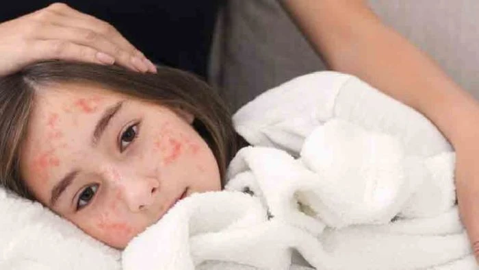 হাম হলে শিশুকে কী খাওয়াবেন, কোন খাবার থেকে দূরে রাখবেন